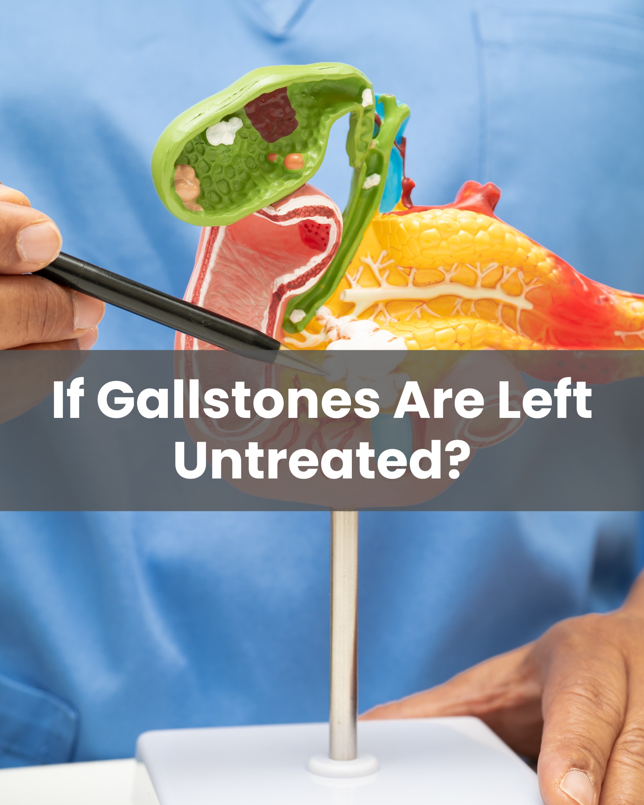 Gallstones