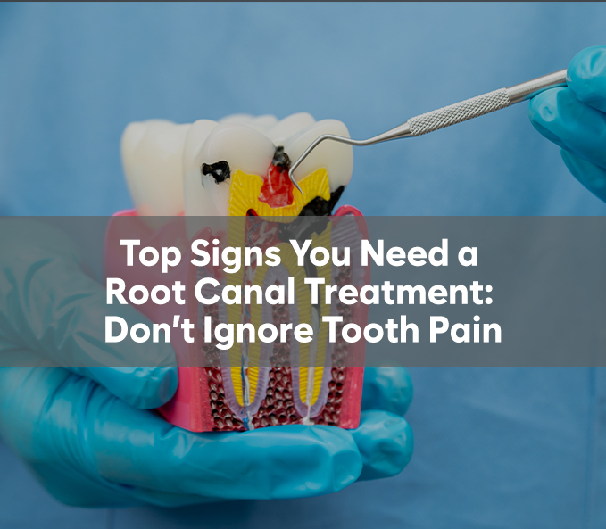Top Signs You Need a Root Canal Treatment: Don’t Ignore Tooth Pain