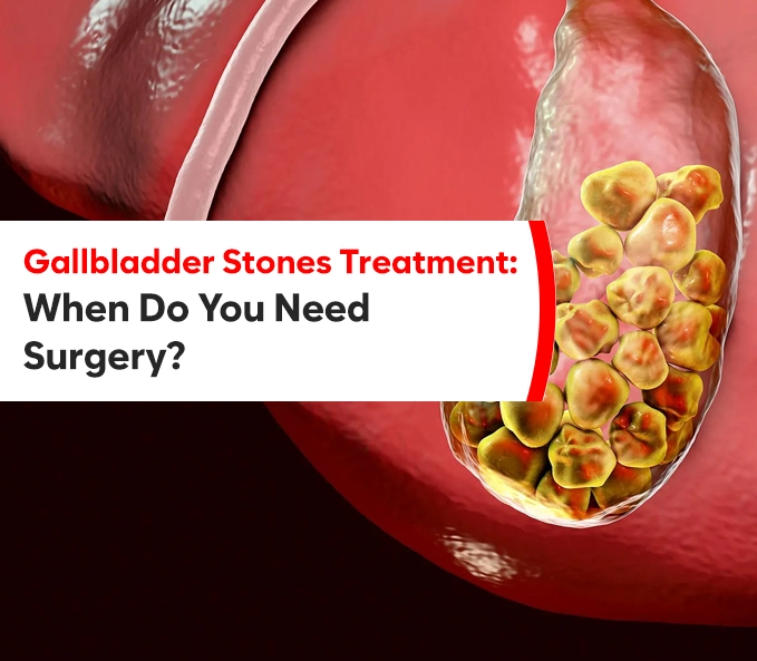 Gallbladder Stones Treatment: When Do You Need Surgery?